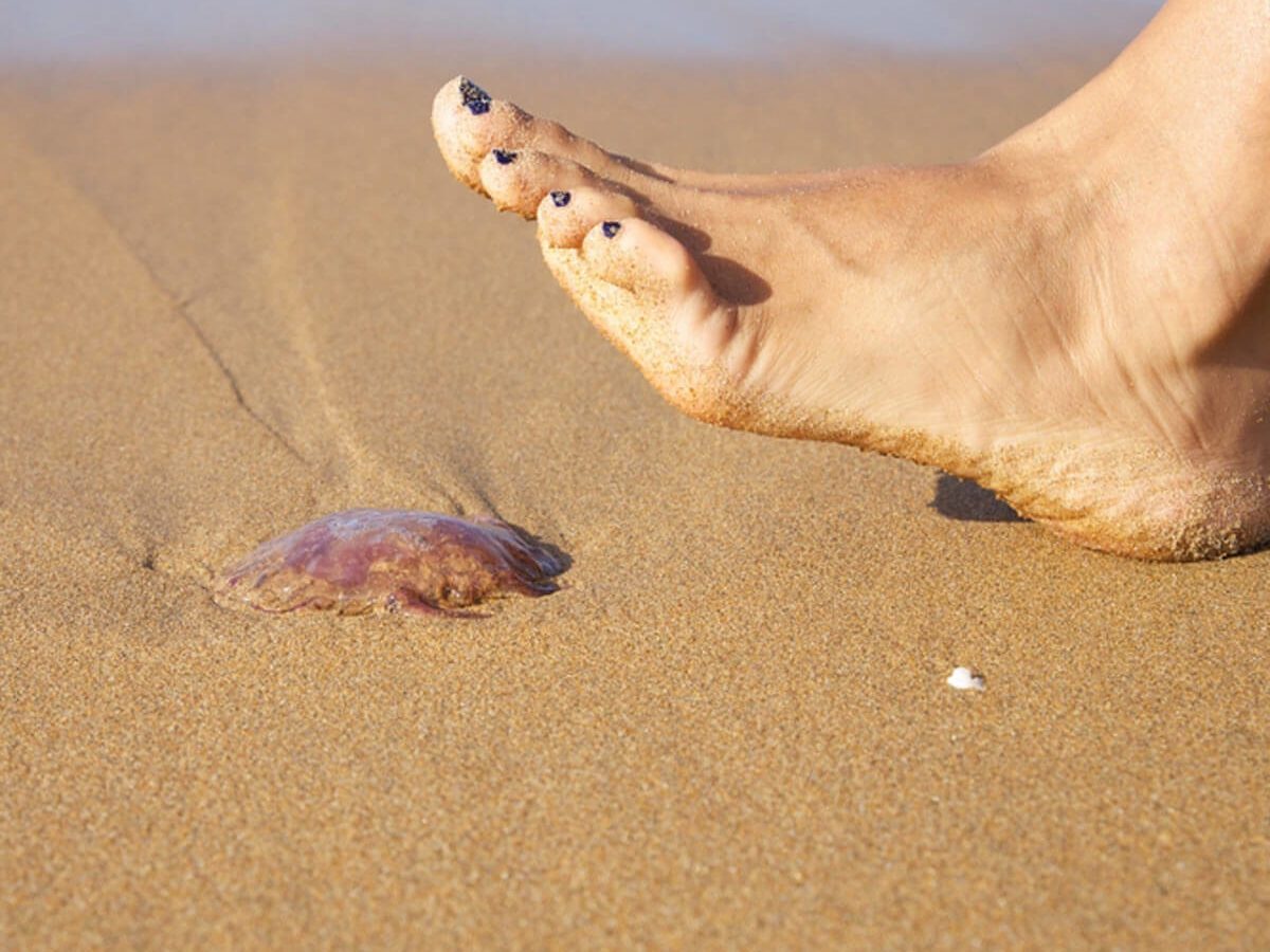 Soothe a Jellyfish Sting