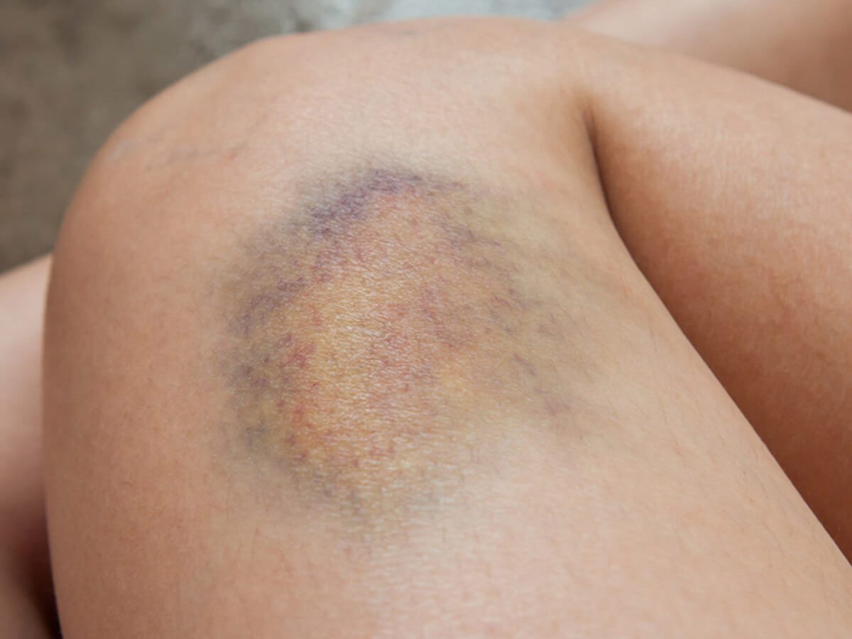 Make Bruises Disappear Quicker